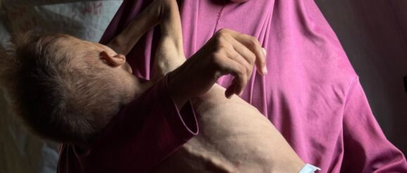 Gaza children's health damaged permanently by malnutrition, doctors warn